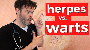 warts vs herpes can you tell