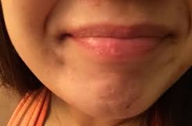 remove old scar tissue from my lip