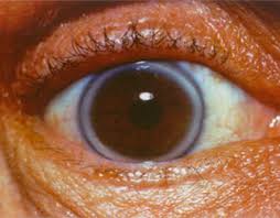 Image result for fat deposits - cholesterol under cornea /pics