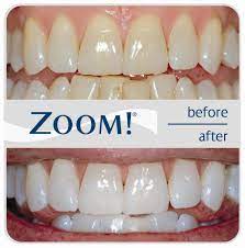 zoom teeth whitening costs reviews