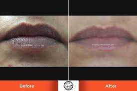 dark lips treatment