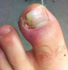 portal ingrowing toenails