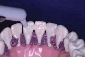 A dental implant is a foreign element that has to be inserted into the bone, while the natural tooth is just restored to its natural position. Periodontal Splint Clinical Applications Ribbond