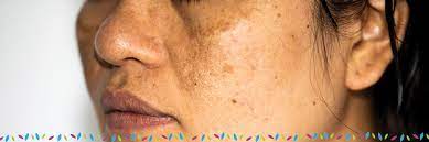 skin discoloration hyperpigmentation