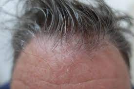 scalp seborrheic dermais treatment