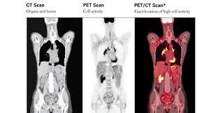pet ct scan university radiology