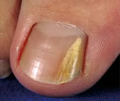 fungal nail infections city glebe