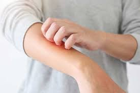 siegel dermatology eczema treatment
