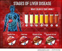 liver disease stock ilration
