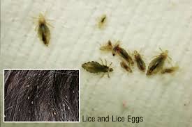 home remes to remove head lice