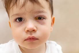 goopy eyes causes and treatment