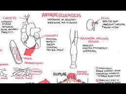 Atherosclerosis Pathophysiology Youtube