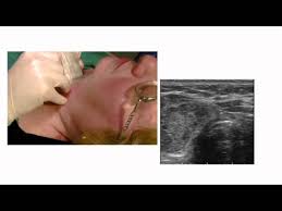 Thyroid fine needle aspiration (fna) and cytology i. Fine Needle Aspiration Thyroid Nodule Graphic Youtube