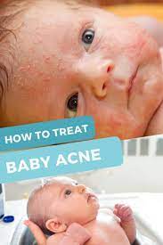 treatment and help for baby acne