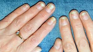 psoriatic arthritis nail damage
