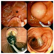 Image result for endoscopy stone