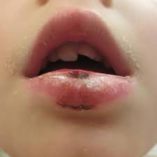 lip lacerations after a fall the bmj