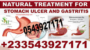 stomach ulcer cine 0543927171