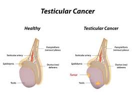 A person may feel a rubbery or hard. What Abnormalities Did You Notice Before You Were Diagnosed With Testicular Cancer Quora