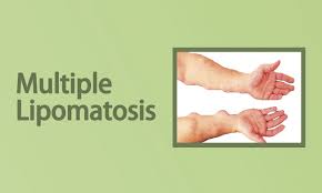 multiple lipomatosis