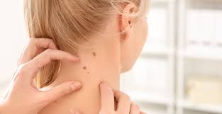 Skin Tag Removal Treatment in Hyderabad at Skin Bliss Clinic