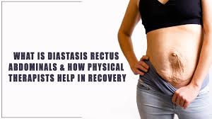 what is diastasis rectus abdominals