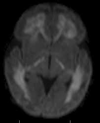 Maybe you would like to learn more about one of these? Periventricular Leukomalacia Mri Sumer S Radiology Blog