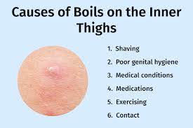 treat boils on inner thighs