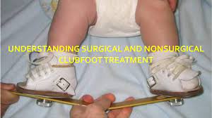1 in 800 children worldwide are born with clubfoot, a congenital birth defect causing the feet to point inward and upward. Understanding Surgical And Nonsurgical Clubfoot Treatment By Kids Orthopedic Issuu