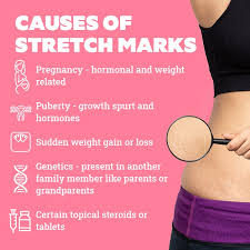 stretch marks in agers