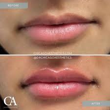 lip injections before after chicago