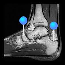 Routine ankle magnetic resonance imaging (mri) tests involve taking images of the foot the mri machine uses radio wave energy pulses and a magnetic field to produce the foot and ankle images. Anatomy Of The Foot And Ankle Mri