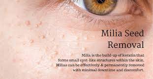 milia seed removal top 3 treatment methods