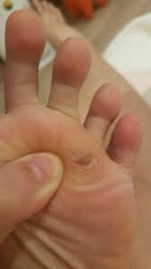 for treatment of a plantar wart how