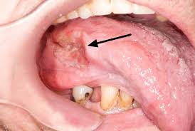 cavity cancer causes symptoms
