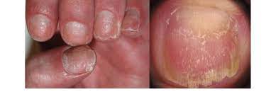 nail fragility due to nail matrix
