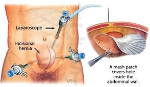 laparoscopic abdominal hernia surgery