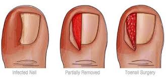 fi myths about ingrown toenails