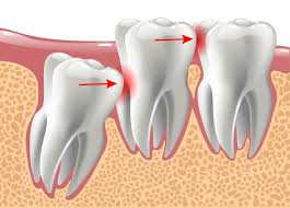 wisdom tooth removal and what you