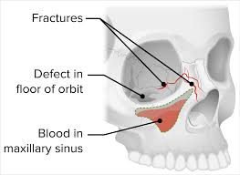orbital fractures concise cal