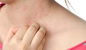 What might happen after the rash has appeared? A Rash With Flu Like Symptoms What Could It Be Skin Care