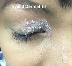 dermais and eczema of the eyelids