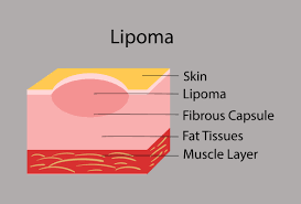 lipoma and when should it be removed