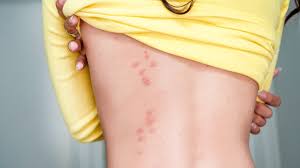 To best identify bed bug bites, look for typical insect bites or red welts on your skin. Bed Bug Bites Symptoms And Treatments