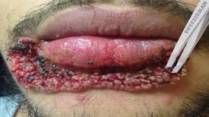 worst lip pimples on you you