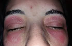 allergic contact dermais to tinosorb