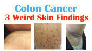 3 weird signs of colon cancer found on