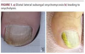 onchomycosis an overview jdd