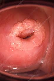 warts on the cervix inspection