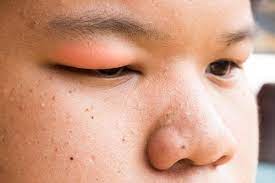swollen eyelids causes how to fix